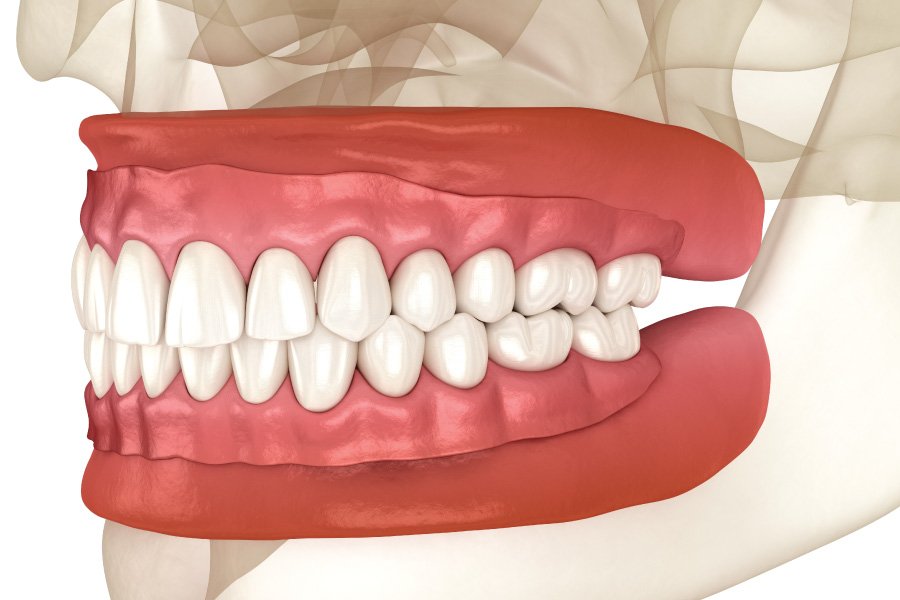 North Bend Full Dentures